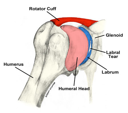 picture of a torn labrum